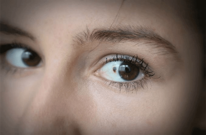 Los investigadores crean avatares tumorales que prueban nuevos tratamientos contra el cáncer de ojo