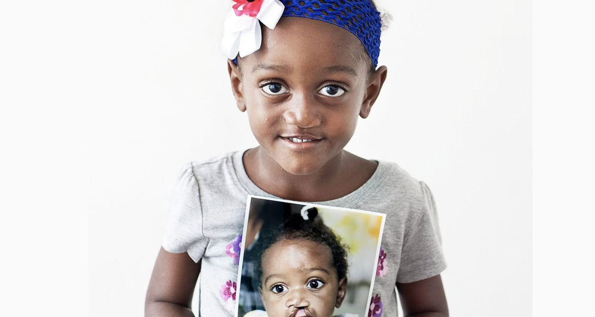 Operation Smile Dominican Republic Foundation mantendrá quirúrgico de labios y paladares gruesos libres