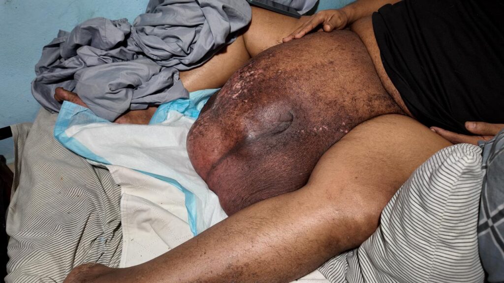 Joan Batista lucha contra un gigantesco tumor que lo mantiene en cama; solicita ayuda para cirugía - Noticias de hoy en República Dominicana | último minuto