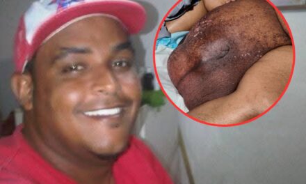 Joan Batista lucha contra tumor ciclópeo