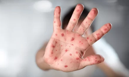 Síntomas, formas de contagio, tratamiento y cómo advertir la enfermedad – RC Noticias