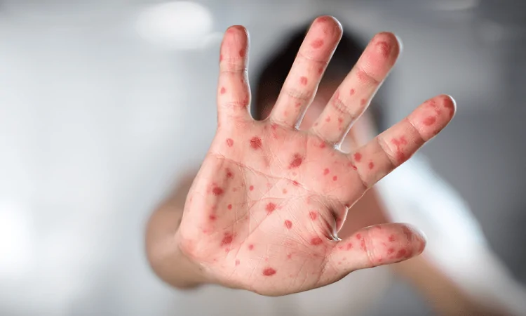 Síntomas, formas de contagio, tratamiento y cómo advertir la enfermedad – RC Noticias
